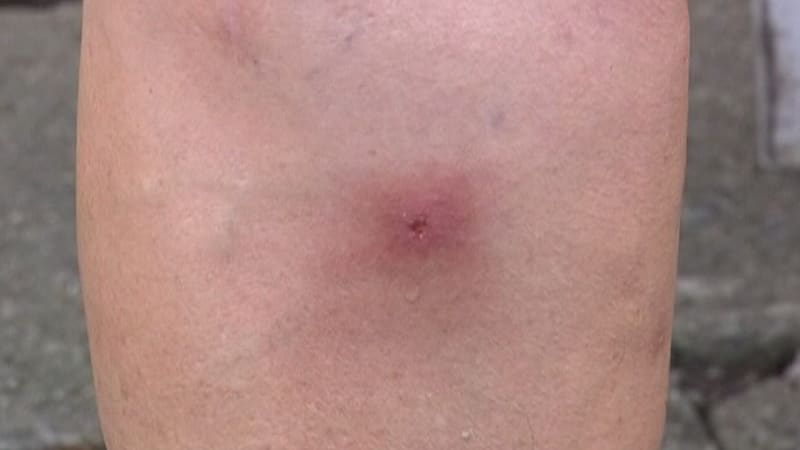 Přibývá lidí alergických na bodnutí hmyzem. V některých případech může být smrtelné