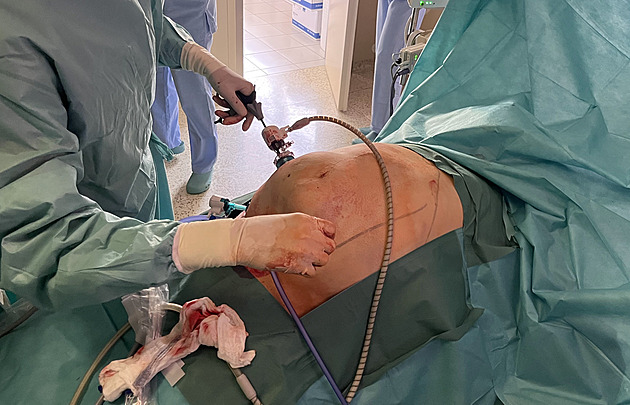 Nemohl se zbavit kýly, pak mu pomohl unikátní zákrok. Musel ale zhubnout